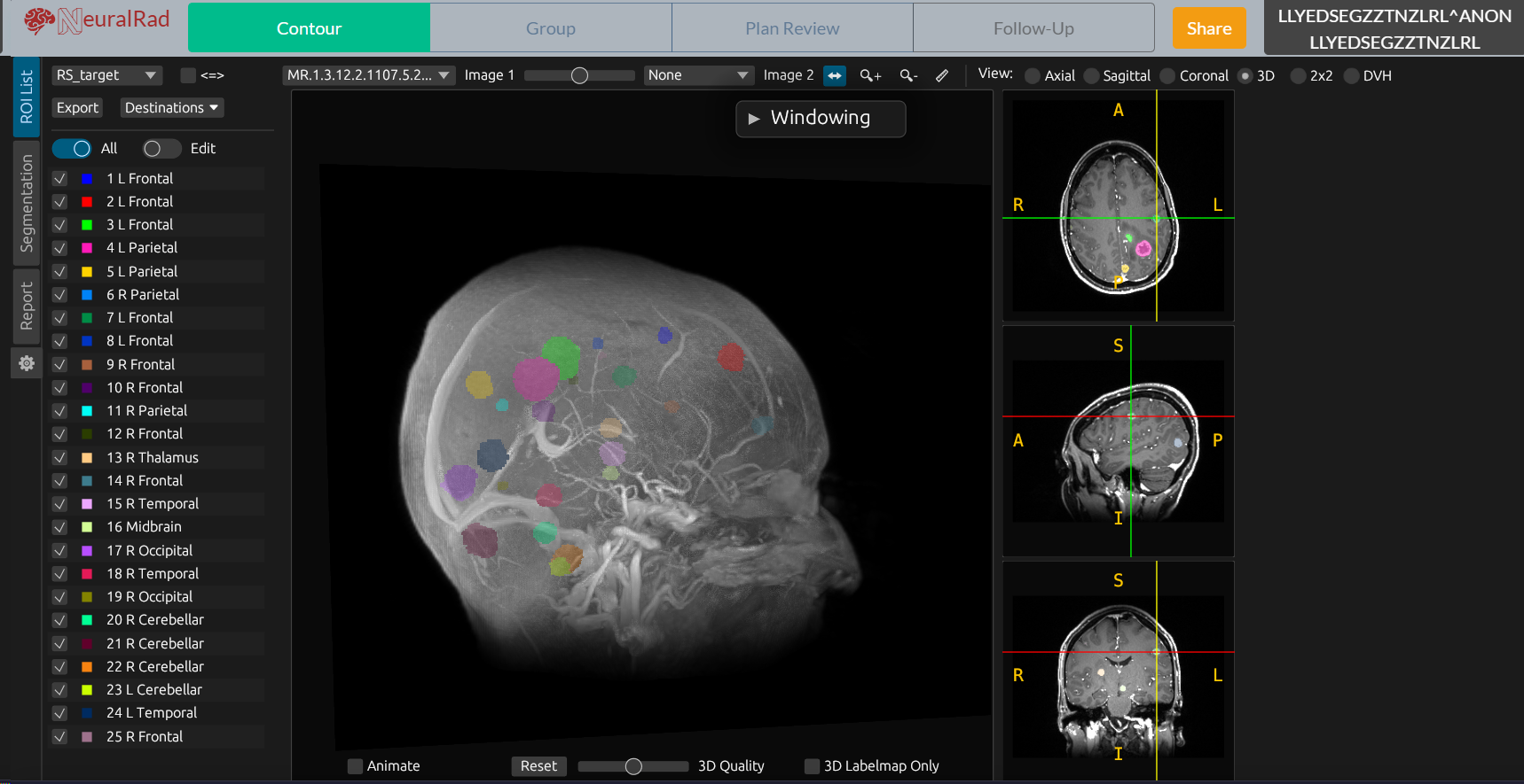 NeuralRad Brain - Automated brain metastasis segmentation with 3D visualization
